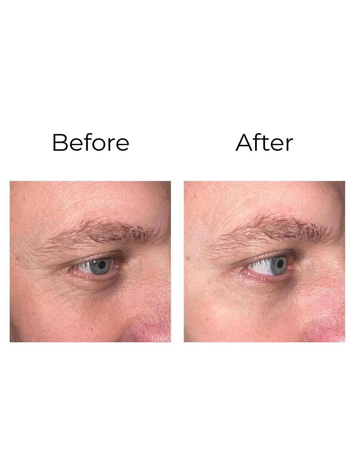 Anti-wrinkle eye contour cream “shock action effect” with LIPHASYN™ 20 ml