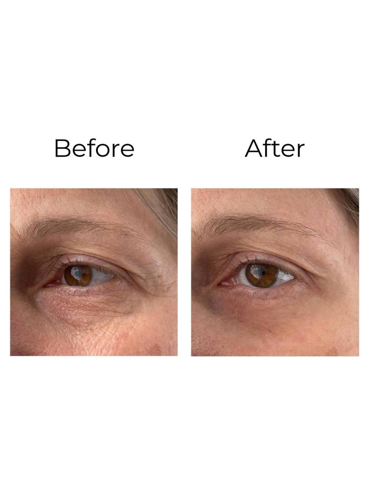 Anti-wrinkle eye contour cream “shock action effect” with LIPHASYN™ 20 ml